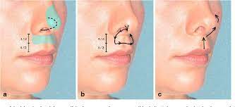 The No Scar Lip Lift Upper Lip Suspension Technique Semantic Scholar Upper Lip Lip Surgery Lips