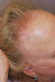 I was diagnosed with oral lichen planus, which is an auto immune system disorder causing ulcers and burning in the mouth. Frontal Fibrosing Alopecia The Trichological Society