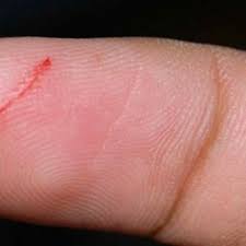 Paper Cut Remedy - Hubpages