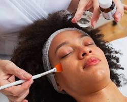 Image of Chemical peel treatment