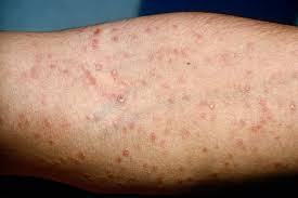 Image result for syphilis symptoms