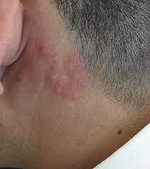 Insect Bite Online Dermatology