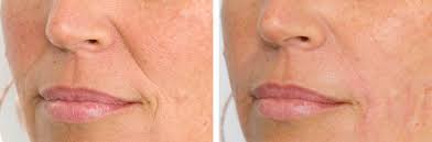 Dubrow believes in achieving beautiful aesthetic results with minimal treatment. Dermal Filler For Nose To Mouth Lines Smile Lines