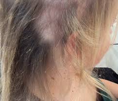 With this condition, your body mistakenly views your hair. Hilfe Und Beratung Bei Alopezia Und Alopezie