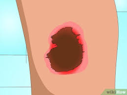 We recommend roc's retinol correxion. 4 Ways To Get Rid Of Acne Scabs Fast Wikihow