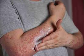 Image result for syphilis symptoms