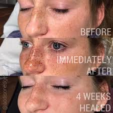 FRECKLES & LASHLINE PORTFOLIO — ADDISON EDGE