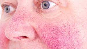 Rosacea Symptome Von Rotungen Bis Hautwucherungen Zava Dred