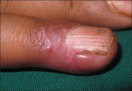 glomus tumour on the right ring finger