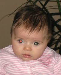 The retina is a thin layer of nerve tissue that coats the back of the eye and enables the eye to see. White Eye And Retinoblastoma We C Hope