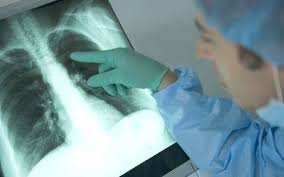 The cancer can happen in any part of the lung tissue. Is My Cough A Lung Cancer Cough