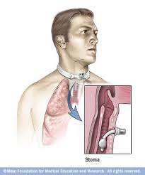Tracheostomy Medical Surgical Nursing Tracheostomy Tracheostomy Care