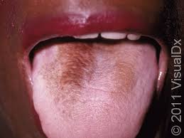 Image result for black hairy tongue symptoms