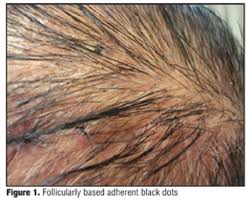 It can be helpful to see a dermatologist to make sure you have folliculitis. Black Dot Tinea Capitis In An Immunosuppressed Man Jcad The Journal Of Clinical And Aesthetic Dermatology