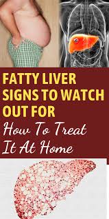 Fatty Liver Signs To Watch Out For And How To Treat It How To Get Rid Of Fatty Liver In 2020 Fatty Liver Disease Fatty Liver Fatty Liver Symptoms