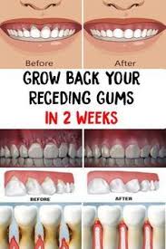 Receding Gums Grow Back Your Receding Gums In 2 Weeks Gum Health Gum Disease Remedies Teeth Health