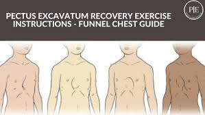 The two most common surgical procedures to repair pectus excavatum are known by the names of the surgeons who first developed them: Pectus Excavatum Recovery Exercises Instructions Funnel Chest Guide By Pectus Excavatum Issuu