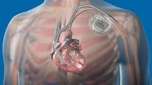 If it occurs, the icd quickly sends an electrical shock to the heart. Advances In Implantable Cardioverter Defibrillator Technology Daic