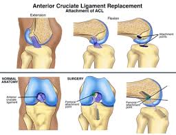 However, recently the trend has changed and there are now better solutions for managing pain. Pain After Acl Surgery Causes And Treatments Enkiverywell
