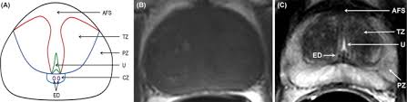 Mri scans can show if the cancer has spread outside the prostate … Multiparametric Mp Mri Of Prostate Cancer Sciencedirect