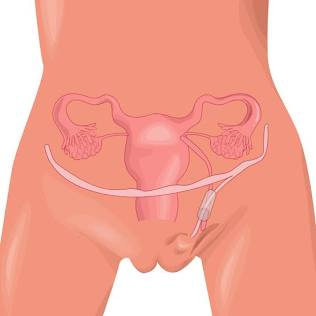 Anatomía Del Canal De Nuck Y Trayecto Del Ligamento Redondo En La Mujer, Generada Por Ia