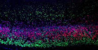 This color is a symbol for children with disabilities, parkinson's disease, and mental illnesses such as severe depression, bipolar disorder, schizophrenia, and anxiety disorders. Brain Cancer Breakthrough Provides Hope For New Treatments Eurekalert Science News