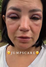 Upper Blepharoplasty Transformation: Before and After