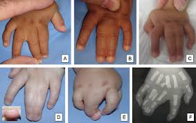 The patient returned to normal life immediately after the procedure. Treatment Of Congenital Syndactyly Sciencedirect