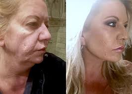 Find over 2 of the best free facelift images. Mini Facelift World Renown Mini Facelift Specialist In New York