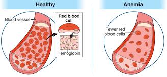 Image result for Anemia angolensis