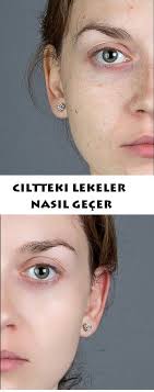 Ciltteki Lekeler Nasil Gecer Cilt Beyazlatma Dogal Cilt Cilt Bakimi