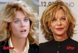 The hollywood actress claims that she has not had any work done. Meg Ryan Before And After Cosmetic Surgery Plastic Surgery Mistakes