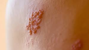 Image result for herpes zoster