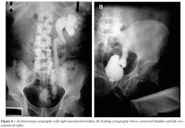 Image result for Genitourinary Tuberculosis