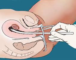 Surgical Abortion Gynmed Ambulatorium Die Adresse Fur Ungewollte Schwangerschaften