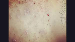 Warm oil treatment for shiny hair. Teenage Acne Open Head Black Stump Ingrown Hair Embedded Right Cheek Youtube