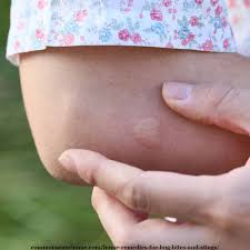 11 pictures of common bug bites and how to identify their symptoms. 20 Home Remedies For Bug Bites And Stings That Itch Swell