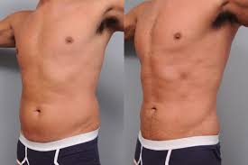 Image result for Liposuction