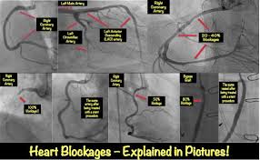 Two major coronary arteries branch off from the aorta near the point where the aorta and the left ventricle meet. Heart Blockage Explained With Pictures Myheart