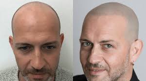 In sostanza con questa tecnica si . Tricopigmentazione Vs Trapianto Capelli Vs Tatuaggio E Perche Sceglierai La Prima Scienze Notizie