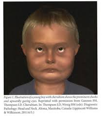 Cherubism is an autosomal dominant disorder that may be related to tooth development and eruption. Cherubism Document Gale Academic Onefile
