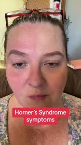 Image result for Anhidrosis