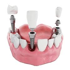 Soluția all on 4 / all on 6 a fost special creată pentru a. Implant Dentar Pret Descriere Etape Dr Aristide Dentist Bun In Bucuresti