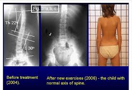 During the physical exam, your doctor may have your child stand and then bend forward from the waist, with arms hanging loosely, to see if one side of the rib cage is more prominent than the other. Child Maria 10 Years Old Scoliosis S I Epg Diminishing Of Curves Download Scientific Diagram