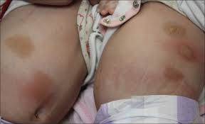 Image result for Urticaria pigmentosa children
