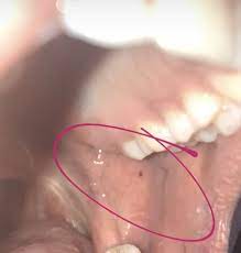 Check spelling or type a new query. Blood Blister Inside Of Cheek In Mouth Babycenter