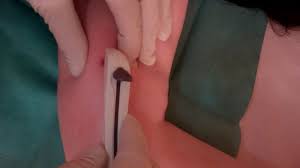 Für welche frauen ist das verhütungsstäbchen geeignet? Dr Med Matthias Stroth Gynakologen In Berlin Offnungszeiten