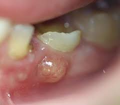 Image result for Periodontal Abscess