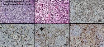 1 department of hematology, iuliu hatieganu university of medicine & pharmacy. Angioimmunoblastic T Cell Lymphoma With Proliferation Of Large B Cells Download Scientific Diagram