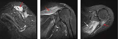 Brachial Neuritis Parsonage Turner Syndrome Shoulder Elbow Orthobullets